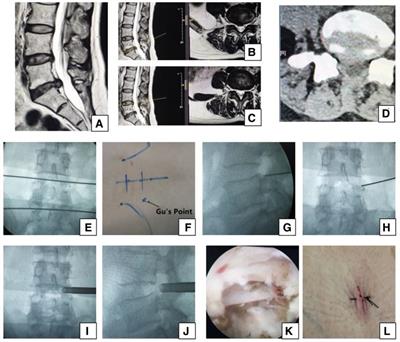 How to predict the culprit segment in percutaneous transforaminal endoscopic surgery under local anesthesia for surgical treatment of lumbar degenerative diseases? Radiologic images or clinical symptoms